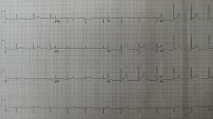 stage I: ST elevation in all leads. PTa depression (depression between the end of the P-wave and the beginning of the QRS- complex)stage II: pseudonormalisation (transition)stage III: inverted T-wavesstage IV: normalisation