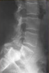 A 26-year-old male presents with chronic back and bilateral leg pain that has not improved with extensive nonoperative management including physical therapy, oral medications, and corticosteroid injections. Radiographs are shown in Figure A. What ...