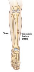 A fracture of the bone, occurring typically in children, in which one side of the bone is broken and the other only bent.