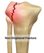 Fracture in which bone retains its normal alignment.