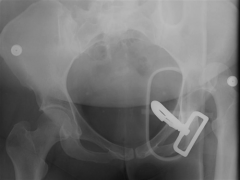 A 41-year-old female sustains the injury shown in Figure A as a result of a high-speed motor vehicle collision. After a successful attempt at closed reduction in the emergency room using conscious sedation, repeat radiographs show a reduced hip jo...