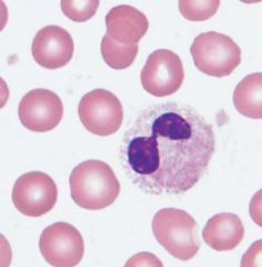 Labs show Macrocytic anemia, hypogranular neutropenia, low plts and the finding to the left