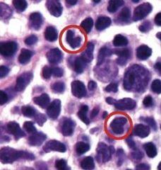 Which Non-Hodgkin Lymphoma has this finding?  What translocation is it associated with?