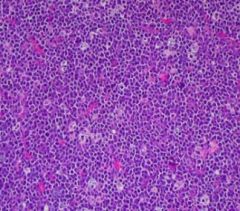 Which Non-Hodgkin Lymphoma has this finding?  What translocation is it associated with?  Diseases?