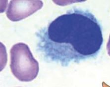 Which Non-Hodgkin Lymphoma has this finding?
