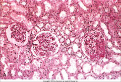 *FSGS. Note accumulation of matrix in the right glomerulus; no more patent capillaries in this tuft.