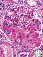 *FSGS Classic Variant.
*Here, there would be podocyte damage, entrapment of plasma proteins (hyalinosis), and increased ECM deposition (sclerosis).
*Hyalinosis comes before sclerosis.