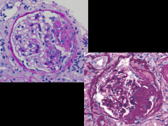 Top: FSGS. This was idiopathic.
Bottom: FSGS. This was secondary to sickle cell.