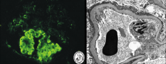 *FSGS Immunofluorescence and EM.
*No IC deposition, but you do see non-specific IgM and complement C3 in areas of sclerosis and hyalinosis (seen on IF).
*On EM, you see effacement of foot processes.