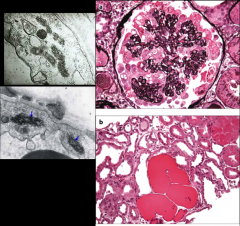 *HIV nephropathy.
*In 5-10% of patients with HIV, more frequent in African Americans.

*Direct effect of HIV on the differentiation and proliferation of podocytes; podocytes proliferate.
*Aggressive clinical course.

*AKA Collapsing glomerul...