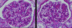 *Diffuse and nodular mesangial sclerosis in DIABETIC NEPHROPATHY.
*SEE ROBBINS 1142.