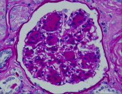 *Kimmelsteil-Wilson nodules IN DIABETIC NEPHROPATHY.
*SEE ROBBINS 1142.
*Lots of GBM and mesangial matrix material, not hypercellularity.
