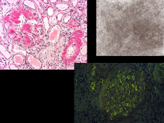 *AMYLOIDOSIS.
*Amorphous deposits in all compartments (can look like diabetes).

*Diagnostic feature: Congo red stain (apple-green birefringence on bottom right).

*On EM: randomly oriented fibrils (amyloid fibers are 8-12 nm diameter).