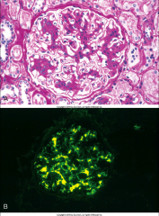 *The most common glomerular disease revealed by renal biopsies worldwide.

*Mesangial proliferation and matrix increase.

*Mesangial deposition of IgA (IgA1), less IgG or IgM.

*Activation of alternative complement pathway (C3 in deposits).
...