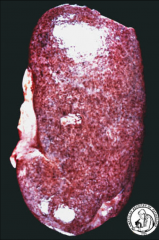 *Poststreptococcal GN.
*Gross Findings
1) Swelling of the kidney.
2) A “flea-bitten” appearance caused by the RBCs.