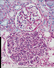 *Top: Normal.

*Bottom: Poststreptococcal GN.
*Diffuse and global glomerular proliferation.
*Glomeruli are:
-Enlarged
-Hypercellular (leukocytes, endotelial, mesangial, crescents in severe).