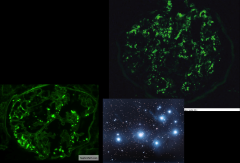 *Immunofluorescence microscopy of post-strep GN.
*Coarsely granular deposits of IgG, IgM, and C3 in in the mesangium and along the GBM.
*Bottom left shows IgG.
*Top right shows C3. 
*Both show "Starry sky" appearance.

*Compare to MN, which ...
