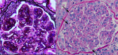 *The pattern of injury in MPGN.
-Enhanced lobulation of the capillary tufts (left).
-Endocapillary and mesangial hypercellularity (right).
-Double contours with cellular interposition (right).
*ROBBINS 928.