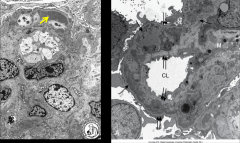 *Electron Microscopy in Type I MPGN:
L: Subendothelial and mesangial deposits. Arrow points to the second layer of BM; first layer is right on top of the capillary. This is a double contour.

R: Split membranes and mesangial deposits. Complex p...