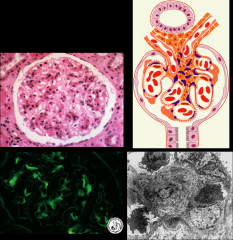 *Mesangial Lupus GN. Early stage lupus nephritis (class I/II).
*Increased mesangial matrix.
*> 3 mesangial cells/mesangial area.
*Immune deposits (“full house”-IgG,M,A C3,C1q).