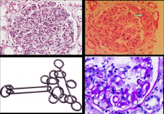 *Diffuse Proliferative lupus GN (class IV).
*More than half of glomeruli are affected; nearly all of them.
*Top left looks kind of like post-strep GN.
*Top right shows crescent formation.
*Bottom right shows "wire loop" structure with a pseudo...
