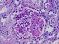 *Hyaline “pseudo-thrombi” in lupus nephritis. You see the thrombi precipitating out within the glomerular capillaries.