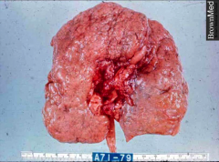 Gross kidney in Chronic Glomerulonephritis, nearing ESRD. Cortical scars lead to a granular surface.