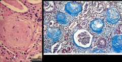 *Chronic Sclerosing Glomerulonephritis; nearing end stage. Trichrome stain on right shows abundant collagen. There's only one remaining glomerulus here.