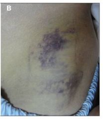 Bruising/echymosis of the flanks suggestive of retroperitoneal hemorrhage in severe pancreatitis with necrosis.

Takes 24-48 hours to appear.