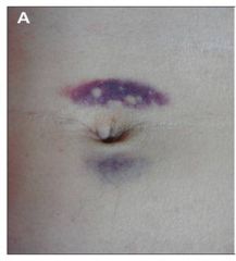 Echymosis/bruising of the periumbilical area suggestive of pancreatitis with necrosis.

Takes 24-48 hours to appear.