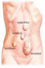 1. Ventral Hernia
2. Umbilical
3. Incisional
4. Epigastric
5. Diastasis recti