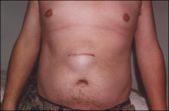 Deep wound infection (most common)
Obesity
Steroid dependence
Multiple prior operations
