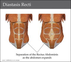 Fascial weakness, not a true defect, rectus muscle separate in the upper midline.
Treatment:
- Reassurance
- Weight loss
- Abdominal muscle strengthening