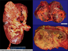 *Gross specimens of CC RCC.
*Left pic shows tumor in the renal vein.