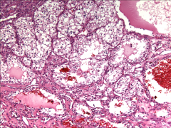 *Clear Cell RCC.
*Note clear cytoplasm and rich vasculature.
