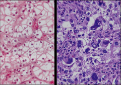 *Clear Cell RCC.
*L: Low grade. Better differentiated. Nuclei aren't so large.
*R: High grade. Poorly differentiated. Nuclei are huge.