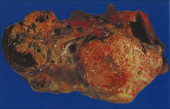 *Gross kidney in VHL. Shows multiple cysts and multiple tumors. You can see the yellow color that's characteristic of CC RCC.