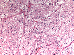 *Chromophobe RCC. Cells are LARGE, and they contain some eosinophilic cytoplasm. They line up along capillaries.