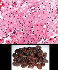 *Solid sheets.
*Concentration of large cells around blood vessels.
*Prominent cell membranes.
*Pale eosinophilic cytoplasm.
*Irregular, wrinkled, rasinoid nuclei.
*Perinuclear halo.
