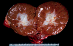 *Oncocytoma.
*Mahogany brown with a central scar.