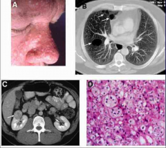 *Caused by Mutations in BHD Gene.

*Benign skin tumors:
-Fibrofolliculoma
-Trichodiscoma
-Acrochordon

*Pulmonary cysts.

*Renal cell tumors (Chromophobe RCC, oncocytoma, hybrid tumors with features of both.)

*BHD gene is on chromosome...
