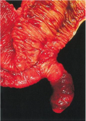 A bulge or pouch off the small intestine. Remnants of the yolk sac stalk.
Present in 1 in every 50 people.
Most people show no symptoms, although intestinal blockage or bleeding may sometimes result.