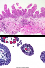 *Urothelial Papilloma.
*<1% of bladder tumors
*Younger patients
*Usually single lesions
*Discrete papillary growth
*Central fibrovascular cores
*No atypia
*Rare recurrences or progression. Benign.