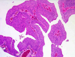 *Somewhere in b/t malignant and benign.
*Thickened urothelium (> 7 layers).
*Orderly arrangement of cells within papillae.
*Minimal architectural abnormalities.
*Minimal nuclear atypia.
*Mitotic figures rare.
*May recur or rarely progress to...