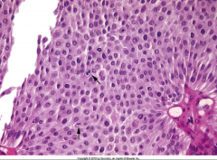 *High power view of Low-Grade Papillary Urothelial Carcinoma.
*Cells maintain polarity.
*Scattered hyperchromatic nuclei.
*Infrequent mitotic figures.
*Mild variation in nuclear size and shape.