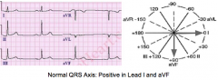 If the QRS complex is upright (positive) in both lead I and lead aVF, then the axis is normal.