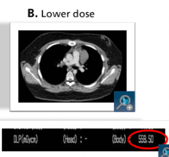 Lower Dose Exam
DLP 559
Grainer Image
But Diagnostic
Much Lower "Dose"
-Need Balance:
Best vs Acceptable (Diagnostic) Image