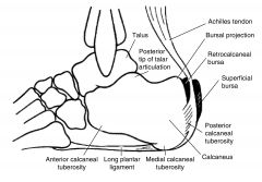 achilles tendon inserts here