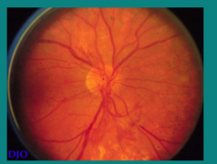 What disease does this patient have? 
 
What are the light spots at the bottom of the image?
 
What is happening in the inferior region below the optic disc?