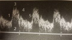 What are the 5 components of this waveform?